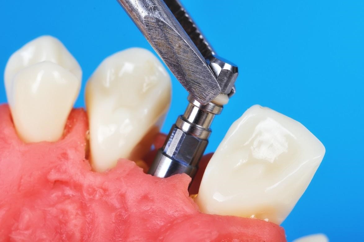 dental implants