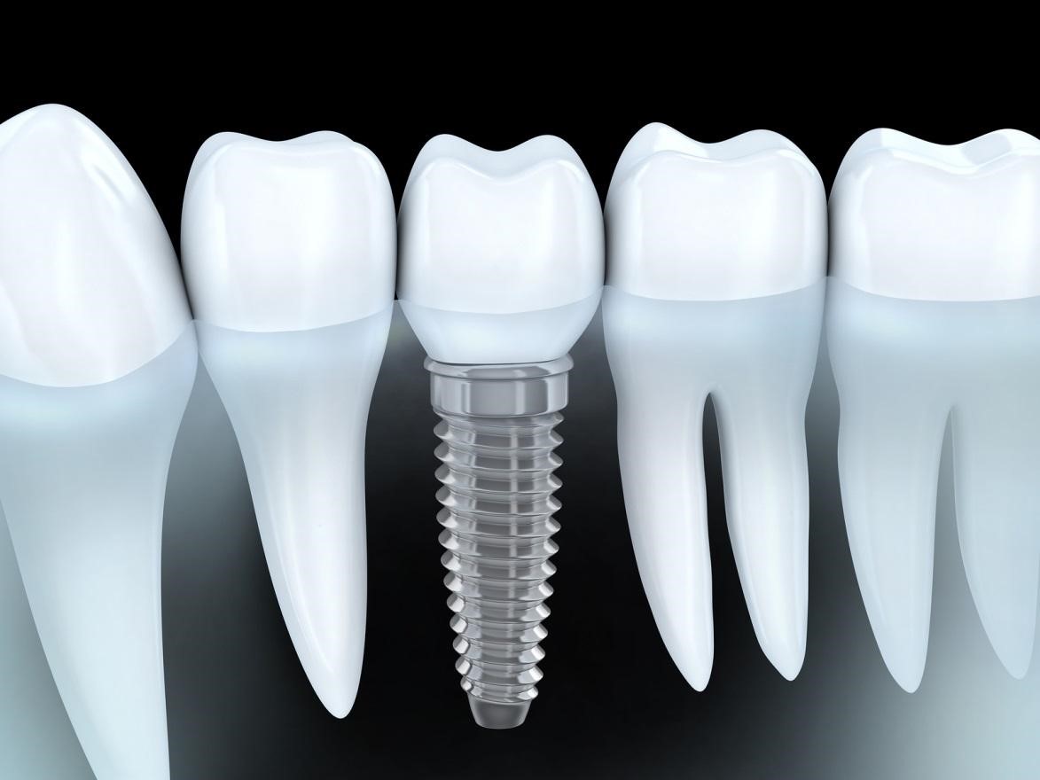 getting dental implants