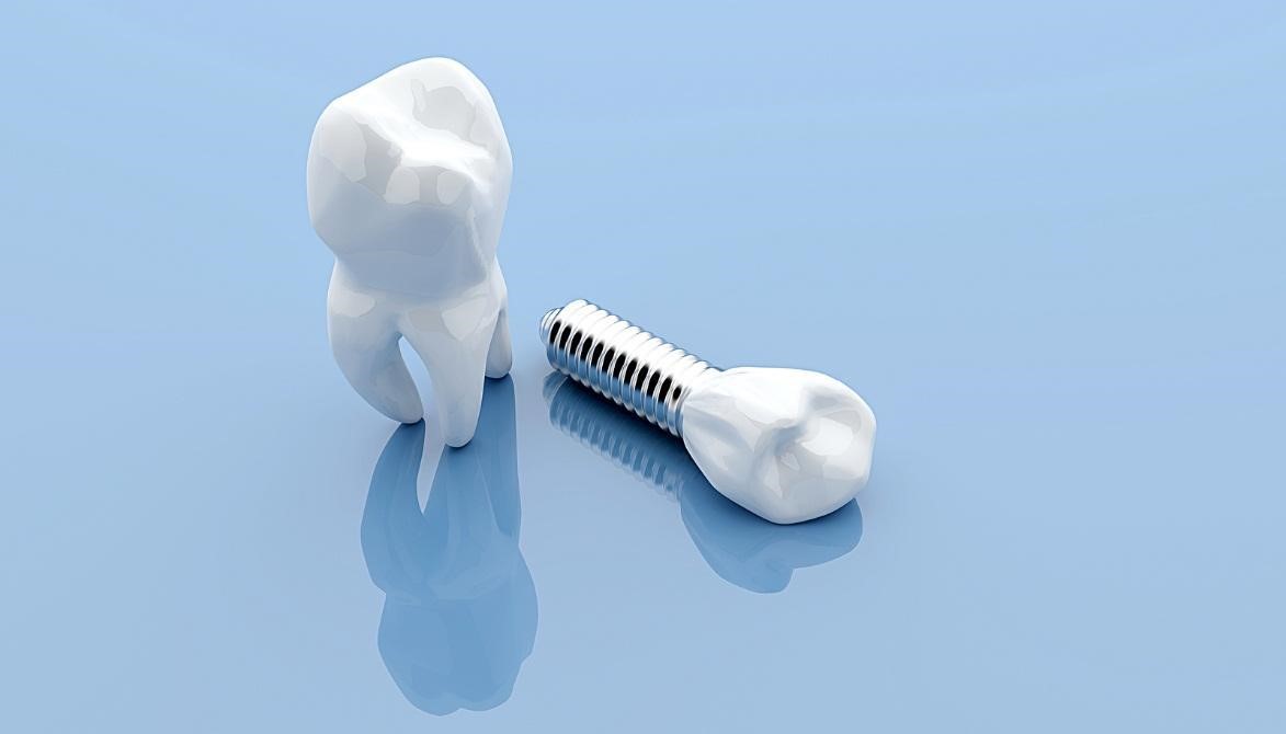 popularity of dental implants