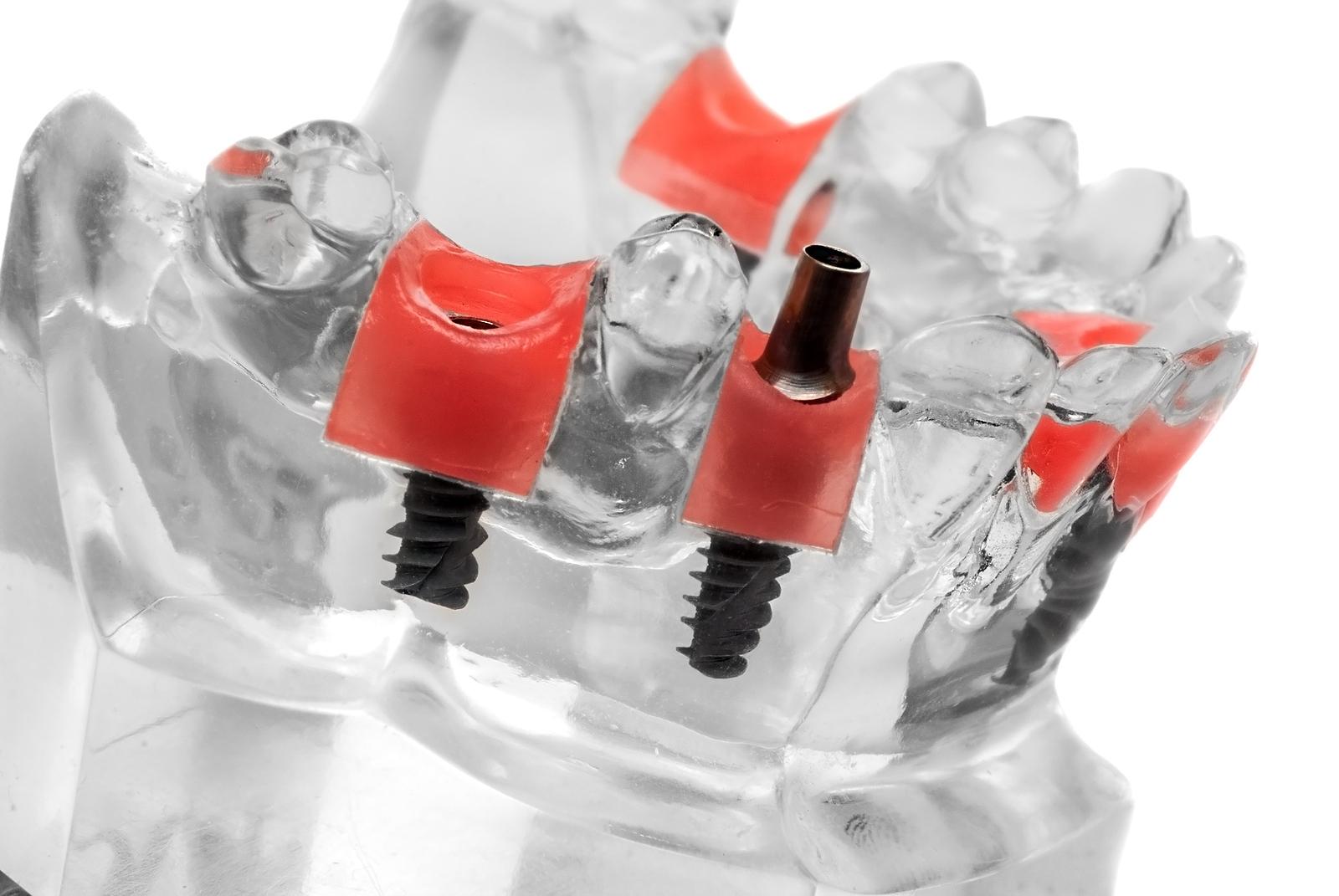 Dental Implants