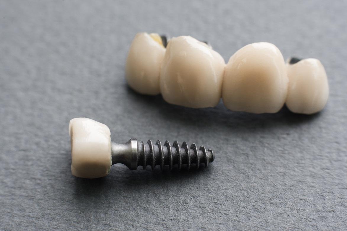 Dental Implants