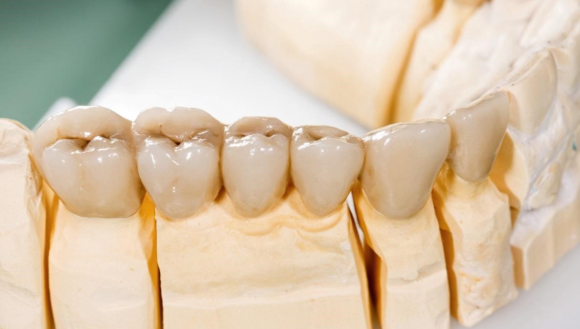 understanding bridges and crowns